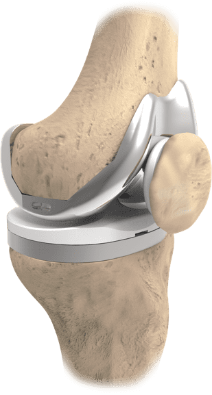 Total Knee Replacement | Hip And Knee Implants | United Orthopedic ...